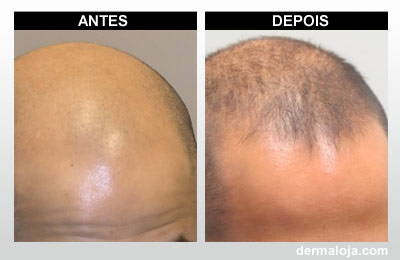 Microagulhamento com Dermaroller e Dermapen - Antes e depois calvície e alopecia
