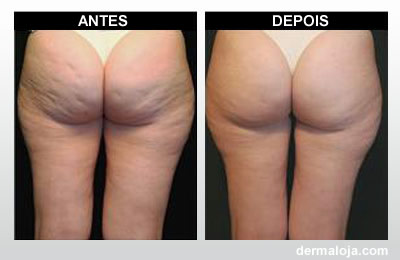 Microagulhamento com Dermaroller e Dermapen - Antes e depois celulite e flacidez da pele