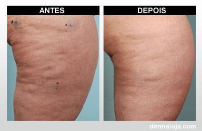 Microagulhamento com Dermaroller e Dermapen - Antes e depois celulite