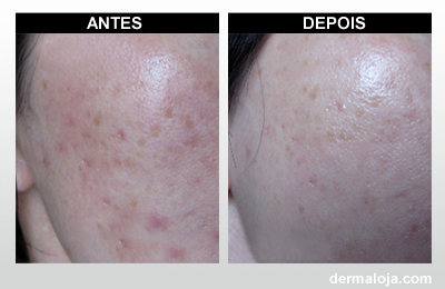 Microagulhamento com Dermaroller e Dermapen - Antes e depois cicatriz de acne com hiperpigmentação