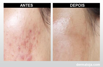 Microagulhamento com Dermaroller e Dermapen - Antes e depois cicatriz de acne hipertrófica