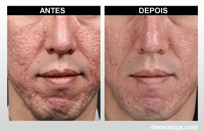 Microagulhamento com Dermaroller e Dermapen - Antes e depois cicatriz de acne profunda