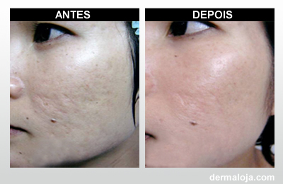 Microagulhamento com Dermaroller e Dermapen - Antes e depois cicatriz de acne