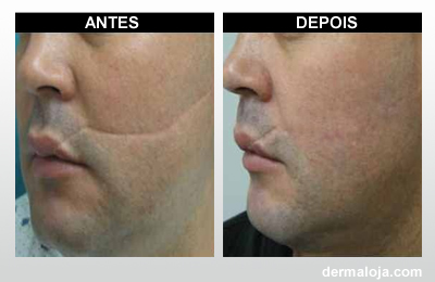 Microagulhamento com Dermaroller e Dermapen - Antes e depois cicatriz atrófica