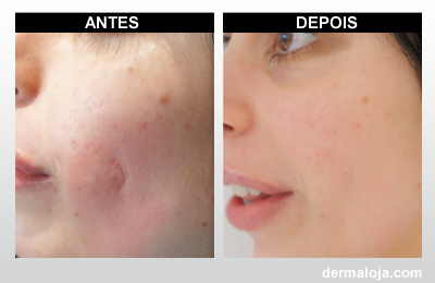 Microagulhamento com Dermaroller e Dermapen - Antes e depois cicatriz por ferida
