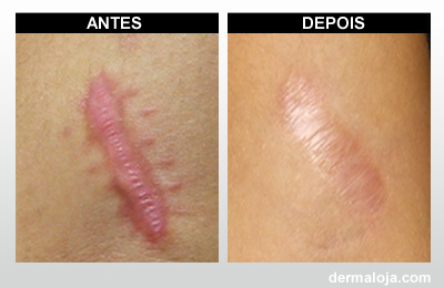 Microagulhamento com Dermaroller e Dermapen - Antes e depois cicatriz hipertrófica