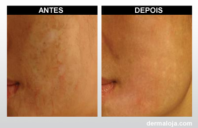 Microagulhamento com Dermaroller e Dermapen - Antes e depois cicatriz por queimadura