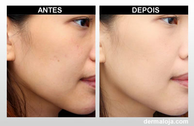 Microagulhamento com Dermaroller e Dermapen - Antes e depois clareamento de manchas
