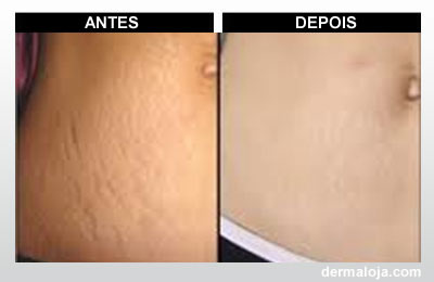 Microagulhamento com Dermaroller e Dermapen - Antes e depois estrias brancas