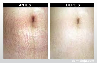 Microagulhamento com Dermaroller e Dermapen - Antes e depois estrias vermelhas