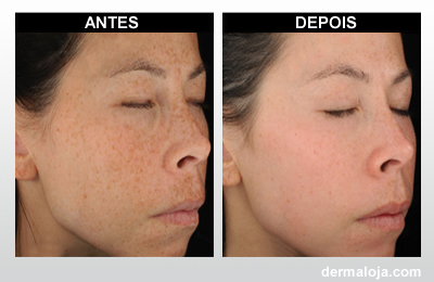 Microagulhamento com Dermaroller e Dermapen - Antes e depois manchas de sol