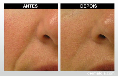 Microagulhamento com Dermaroller e Dermapen - Antes e depois marcas de expressão