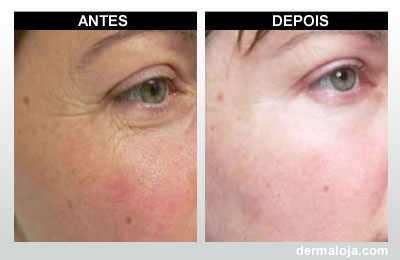 Microagulhamento com Dermaroller e Dermapen - Antes e depois pés de galinha