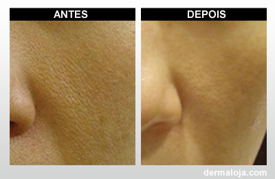 Microagulhamento com Dermaroller e Dermapen - Antes e depois poros abertos