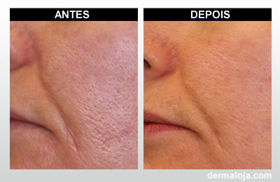 Microagulhamento com Dermaroller e Dermapen - Antes e depois poros profundos