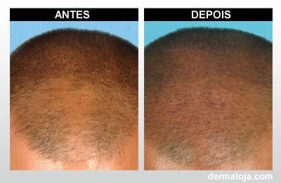 Microagulhamento com Dermaroller e Dermapen - Antes e depois queda de cabelo
