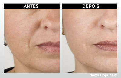 Microagulhamento com Dermaroller e Dermapen - Antes e depois rejuvenescimento da pele