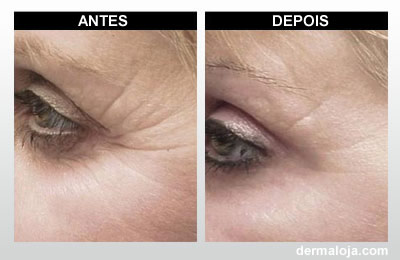 Microagulhamento com Dermaroller e Dermapen - Antes e depois rugas na região dos olhos