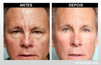 Microagulhamento com Dermaroller e Dermapen - Antes e depois rugas