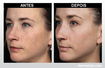 Microagulhamento com Dermaroller e Dermapen - Antes e depois sardas